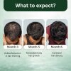 Stage 4 : Hair fall solution
