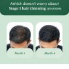 Stage 1 : Hair fall solution